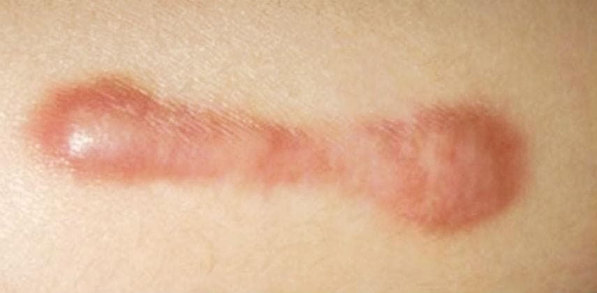 【健康生活】蟹足腫 係乜東東？
